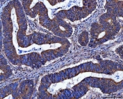 IHC staining of FFPE human colorectal adenocarcinoma tissue with FRY antibody. HIER: boil tissue sections in pH8 EDTA for 20 min and allow to cool before testing.