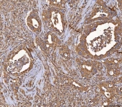 IHC staining of FFPE human appendix cancer tissue with HSD11K antibody. HIER: boil tissue sections in pH8 EDTA for 20 min and allow to cool before testing.