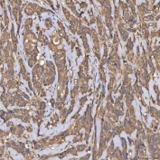 IHC staining of FFPE human breast cancer tissue with HSD11K antibody. HIER: boil tissue sections in pH8 EDTA for 20 min and allow to cool before testing.