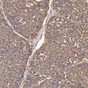 IHC staining of FFPE human liver cancer tissue with HSD11K antibody. HIER: boil tissue sections in pH8 EDTA for 20 min and allow to cool before testing.