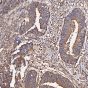 IHC staining of FFPE human endometrial cancer tissue with HSD11K antibody. HIER: boil tissue sections in pH8 EDTA for 20 min and allow to cool before testing.