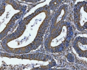 IHC staining of FFPE human colorectal adenocarcinoma tissue with DOCK1 antibody. HIER: boil tissue sections in pH8 EDTA for 20 min and allow to cool before testing.