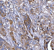 IHC staining of FFPE human breast cancer tissue with FERMT2 antibody. HIER: boil tissue sections in pH8 EDTA for 20 min and allow to cool before testing.