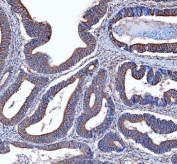 IHC staining of FFPE human colon cancer tissue with FERMT2 antibody. HIER: boil tissue sections in pH8 EDTA for 20 min and allow to cool before testing.
