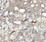 IHC staining of FFPE human renal cancer tissue with FERMT2 antibody. HIER: boil tissue sections in pH8 EDTA for 20 min and allow to cool before testing.