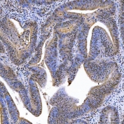 IHC staining of FFPE human intestinal cancer tissue with SAE1 antibody. HIER: boil tissue sections in pH8 EDTA for 20 min and allow to cool before testing.