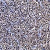 IHC staining of FFPE human ovarian cancer tissue with SAE1 antibody. HIER: boil tissue sections in pH8 EDTA for 20 min and allow to cool before testing.