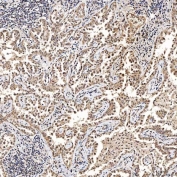 IHC staining of FFPE human lung cancer tissue with SAE1 antibody. HIER: boil tissue sections in pH8 EDTA for 20 min and allow to cool before testing.