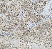 IHC staining of FFPE human squamous cell carcinoma tissue with TBX18 antibody. HIER: boil tissue sections in pH8 EDTA for 20 min and allow to cool before testing.