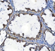 IHC staining of FFPE human ovarian cancer tissue with TBX18 antibody. HIER: boil tissue sections in pH8 EDTA for 20 min and allow to cool before testing.