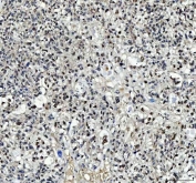 IHC staining of FFPE human lung cancer tissue with TBX18 antibody. HIER: boil tissue sections in pH8 EDTA for 20 min and allow to cool before testing.