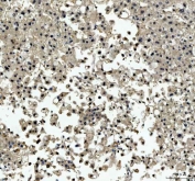 IHC staining of FFPE human liver cancer tissue with TBX18 antibody. HIER: boil tissue sections in pH8 EDTA for 20 min and allow to cool before testing.