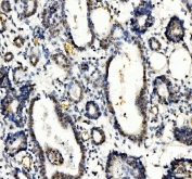 IHC staining of FFPE human colon cancer tissue with TBX18 antibody. HIER: boil tissue sections in pH8 EDTA for 20 min and allow to cool before testing.