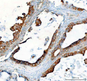 IHC staining of FFPE human ovarian serous adenocarcinoma tissue with SEC22B antibody. HIER: boil tissue sections in pH8 EDTA for 20 min and allow to cool before testing.