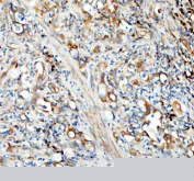 IHC staining of FFPE human colorectal adenocarcinoma tissue with SEC22B antibody. HIER: boil tissue sections in pH8 EDTA for 20 min and allow to cool before testing.