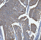 IHC staining of FFPE human cervical squamous carcinoma tissue with S100A14 antibody. HIER: boil tissue sections in pH8 EDTA for 20 min and allow to cool before testing.