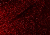 Immunofluorescent staining of FFPE human esophageal squamous carcinoma tissue with SAP18 antibody. HIER: steam section in pH8 EDTA buffer for 20 min.