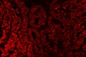 Immunofluorescent staining of FFPE human ovarian cancer tissue with SAP18 antibody. HIER: steam section in pH8 EDTA buffer for 20 min.