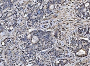 IHC staining of FFPE human duodenal adenocarcinoma tissue with SAP18 antibody. HIER: boil tissue sections in pH8 EDTA for 20 min and allow to cool before testing.
