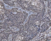 IHC staining of FFPE human esophageal squamous carcinoma tissue with SAP18 antibody. HIER: boil tissue sections in pH8 EDTA for 20 min and allow to cool before testing.