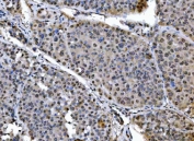 IHC staining of FFPE human liver cancer tissue with SAP18 antibody. HIER: boil tissue sections in pH8 EDTA for 20 min and allow to cool before testing.