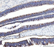 IHC staining of FFPE human colorectal adenocarcinoma tissue with UBA5 antibody. HIER: boil tissue sections in pH8 EDTA for 20 min and allow to cool before testing.