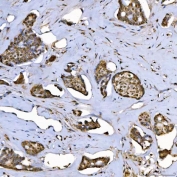 IHC staining of FFPE human breast cancer tissue with SAP130 antibody. HIER: boil tissue sections in pH8 EDTA for 20 min and allow to cool before testing.