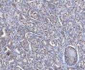 IHC staining of FFPE human prostate cancer tissue with SAP130 antibody. HIER: boil tissue sections in pH8 EDTA for 20 min and allow to cool before testing.