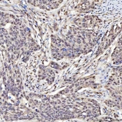 IHC staining of FFPE human ovary tissue with SAP130 antibody. HIER: boil tissue sections in pH8 EDTA for 20 min and allow to cool before testing.