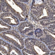 IHC staining of FFPE human endometrial cancer tissue with SAP130 antibody. HIER: boil tissue sections in pH8 EDTA for 20 min and allow to cool before testing.