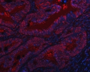 Immunofluorescent staining of FFPE human rectal cancer tissue with SAP130 antibody (red) and DAPI nuclear stain (blue). HIER: steam section in pH8 EDTA buffer for 20 min.