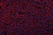 Immunofluorescent staining of FFPE human liver cancer tissue with TRANK1 antibody (red) and DAPI nuclear stain (blue). HIER: steam section in pH8 EDTA buffer for 20 min.