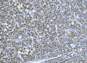 IHC staining of FFPE human liver cancer tissue with TRANK1 antibody. HIER: boil tissue sections in pH8 EDTA for 20 min and allow to cool before testing.