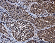 IHC staining of FFPE human liver cancer tissue with MRPP1 antibody. HIER: boil tissue sections in pH8 EDTA for 20 min and allow to cool before testing.