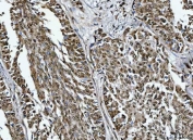 IHC staining of FFPE human lung cancer tissue with MRPP1 antibody. HIER: boil tissue sections in pH8 EDTA for 20 min and allow to cool before testing.