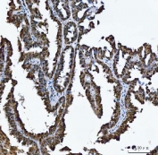 IHC staining of FFPE human ovarian cancer tissue with MRPP1 antibody. HIER: boil tissue sections in pH8 EDTA for 20 min and allow to cool before testing.