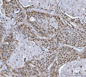 IHC staining of FFPE human lung squamous cell carcinoma tissue with MRPP1 antibody. HIER: boil tissue sections in pH8 EDTA for 20 min and allow to cool before testing.