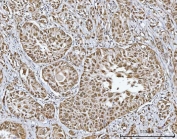 IHC staining of FFPE human breast duct carcinoma tissue with MRPP1 antibody. HIER: boil tissue sections in pH8 EDTA for 20 min and allow to cool before testing.