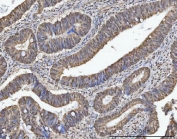 IHC staining of FFPE human colon cancer tissue with MRPP1 antibody. HIER: boil tissue sections in pH8 EDTA for 20 min and allow to cool before testing.