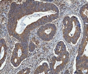 IHC staining of FFPE human colorectal adenocarcinoma tissue with TRMT61B antibody. HIER: boil tissue sections in pH8 EDTA for 20 min and allow to cool before testing.