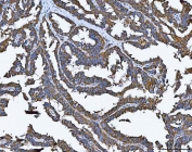 IHC staining of FFPE human ovarian cancer tissue with TRMT61B antibody. HIER: boil tissue sections in pH8 EDTA for 20 min and allow to cool before testing.