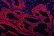 Immunofluorescent staining of FFPE human intestinal cancer tissue with TRMT61B antibody (red) and DAPI nuclear stain (blue). HIER: steam section in pH8 EDTA buffer for 20 min.