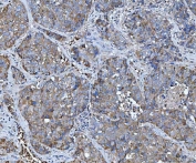 IHC staining of FFPE human liver cancer tissue with TRMT61B antibody. HIER: boil tissue sections in pH8 EDTA for 20 min and allow to cool before testing.