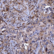 IHC staining of FFPE human appendix adenocarcinoma tissue with Septin 11 antibody. HIER: boil tissue sections in pH8 EDTA for 20 min and allow to cool before testing.