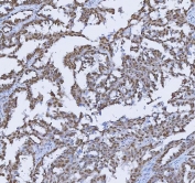 IHC staining of FFPE human ovarian cancer tissue with TRMT6 antibody. HIER: boil tissue sections in pH8 EDTA for 20 min and allow to cool before testing.