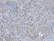 IHC staining of FFPE human breast cancer tissue with TRMT6 antibody. HIER: boil tissue sections in pH8 EDTA for 20 min and allow to cool before testing.