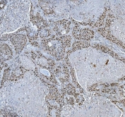 IHC staining of FFPE human lung cancer tissue with TRMT6 antibody. HIER: boil tissue sections in pH8 EDTA for 20 min and allow to cool before testing.