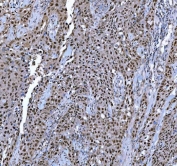 IHC staining of FFPE human testis cancer tissue with TRMT6 antibody. HIER: boil tissue sections in pH8 EDTA for 20 min and allow to cool before testing.