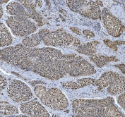 IHC staining of FFPE human liver cancer tissue with TRMT6 antibody. HIER: boil tissue sections in pH8 EDTA for 20 min and allow to cool before testing.