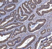 IHC staining of FFPE human colon cancer tissue with TRMT6 antibody. HIER: boil tissue sections in pH8 EDTA for 20 min and allow to cool before testing.